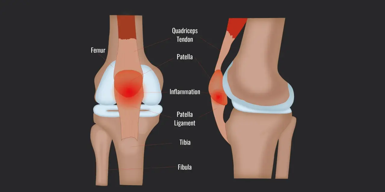 Entzündung der Patella Sehne am Kniegelenk, mit Femur, Patella und Tibia.