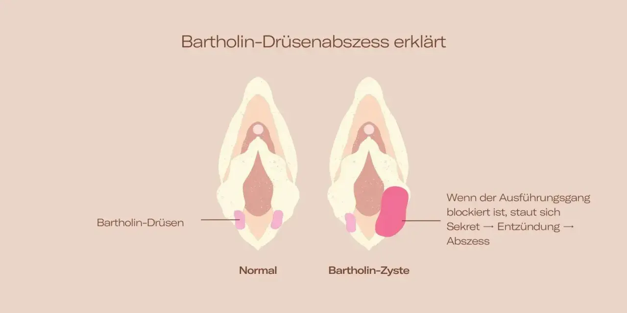Vergleich von normaler Bartholin-Drüse und Bartholin-Zyste/Abszess im Intimbereich. Zeigt, wie Sekretstau zu Entzündung und Abszess führt.