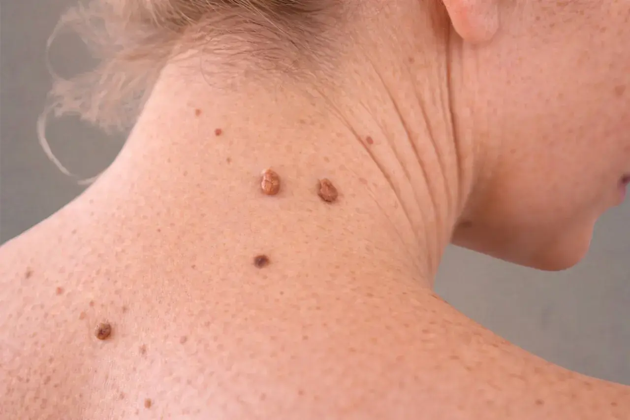 Gros grain de beauté sur le cou, peut-être un molluscum pendulum grossesse.