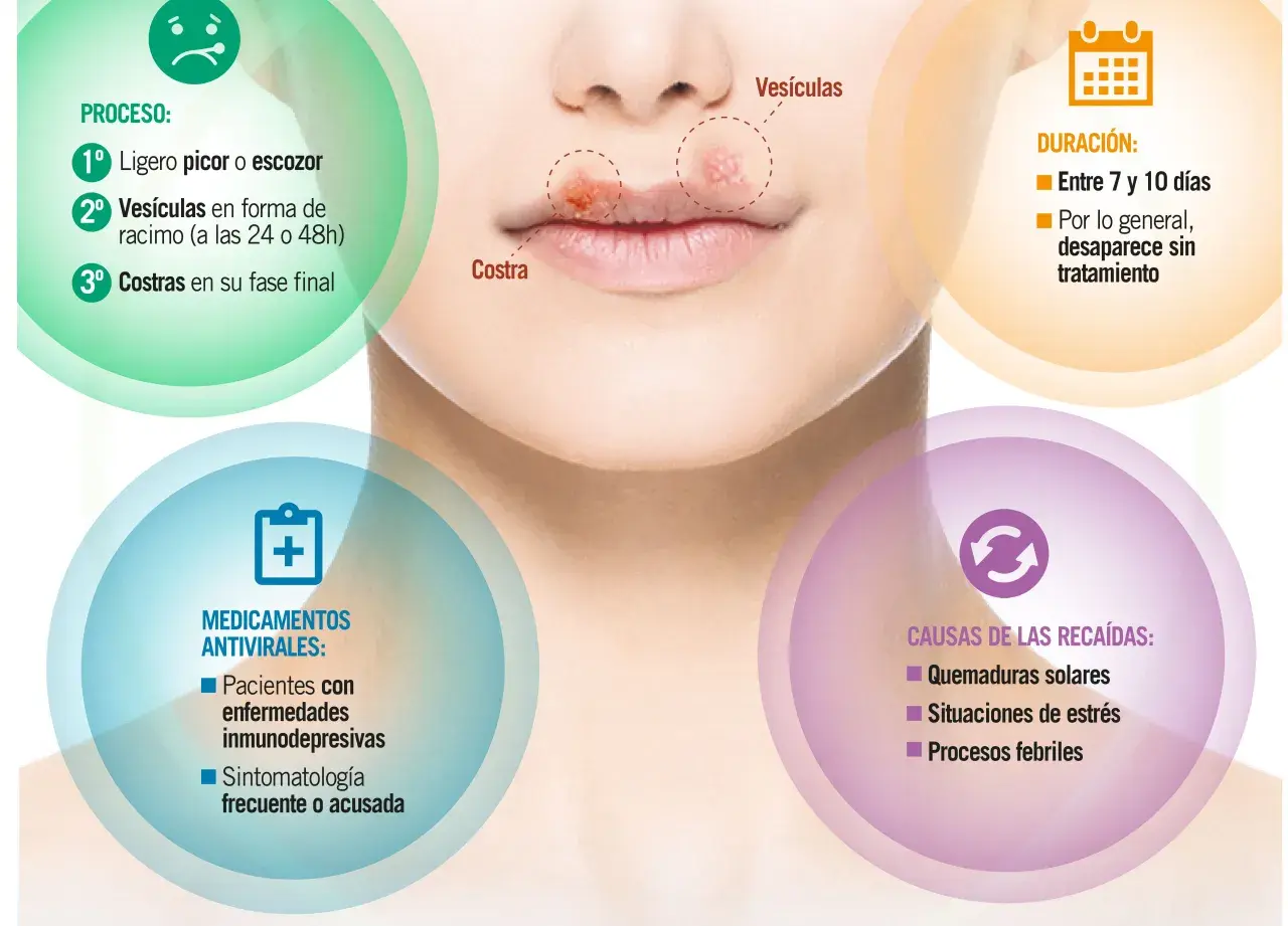 Herpes labial por estrés: el proceso incluye picor, vesículas y costras. Las recaídas pueden ser por estrés.