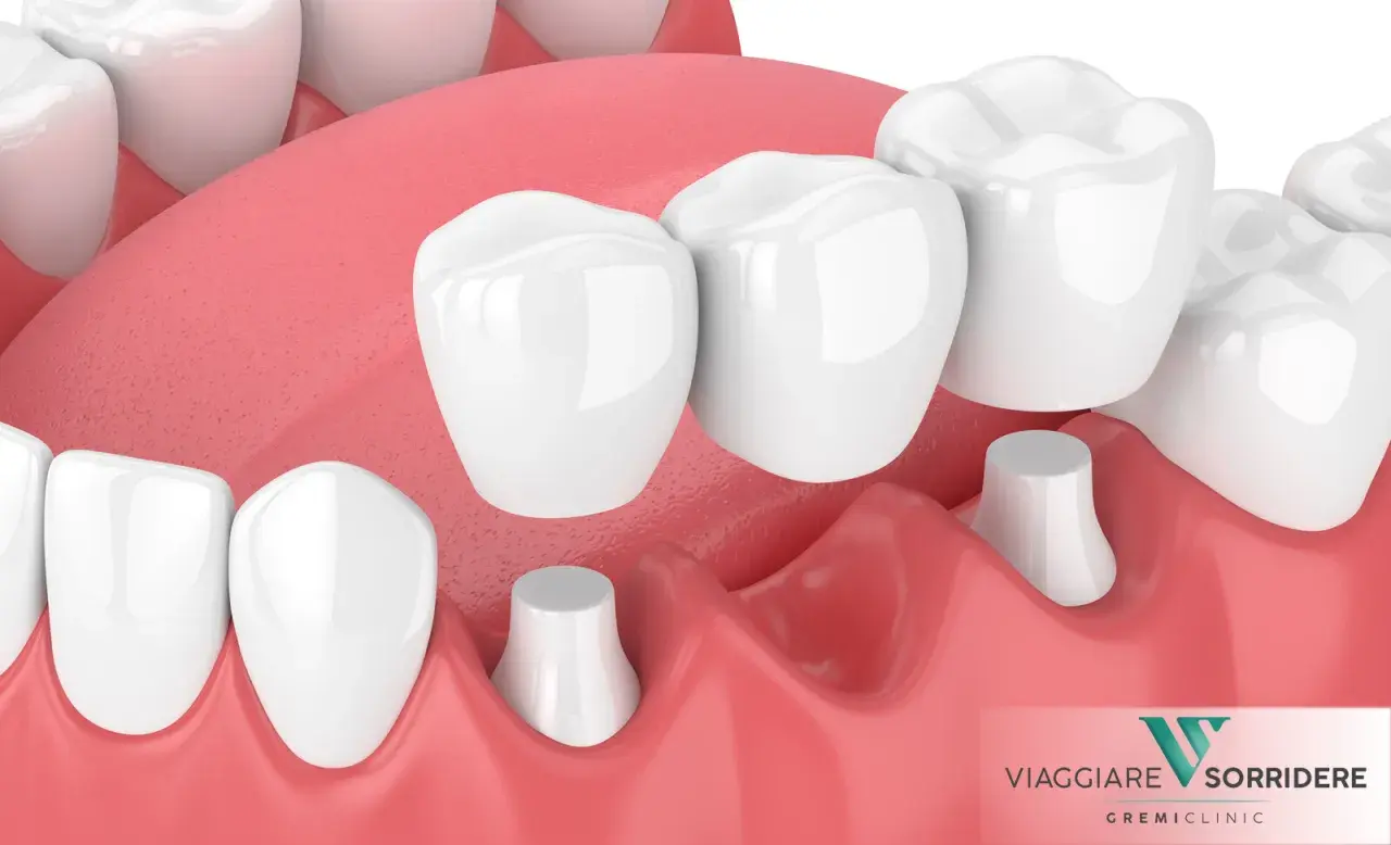 Dettaglio di una capsula devitalizzazione dente, con ponti dentali che coprono monconi preparati.