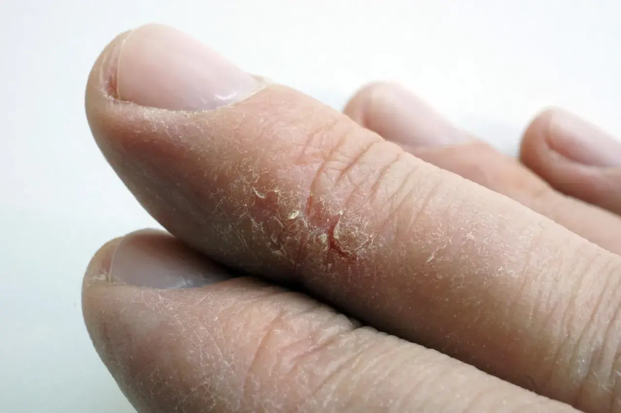 Detalle de dedos con piel seca y agrietada, mostrando la necesidad de tratamiento para grietas en los dedos de las manos como curarlas.