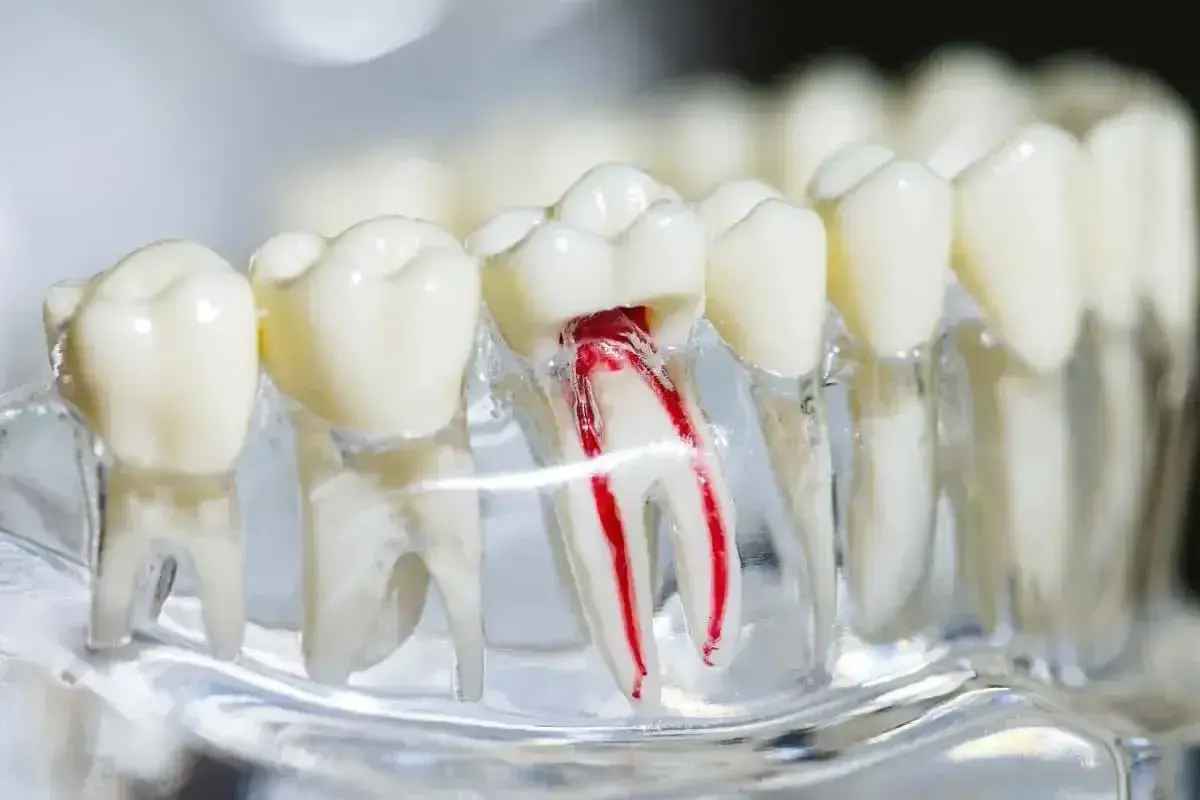 Model zęba z widocznym uszkodzonym kanałem korzeniowym, ilustrujący potrzebę leczenia endodontycznego.