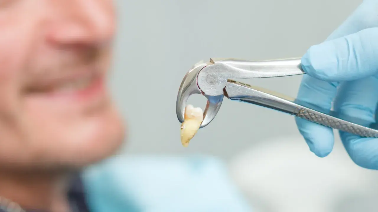 Dentysta pokazuje wyrwany ząb. Czy po wyrwaniu zęba można iść do pracy? Zależy od samopoczucia i rodzaju pracy.