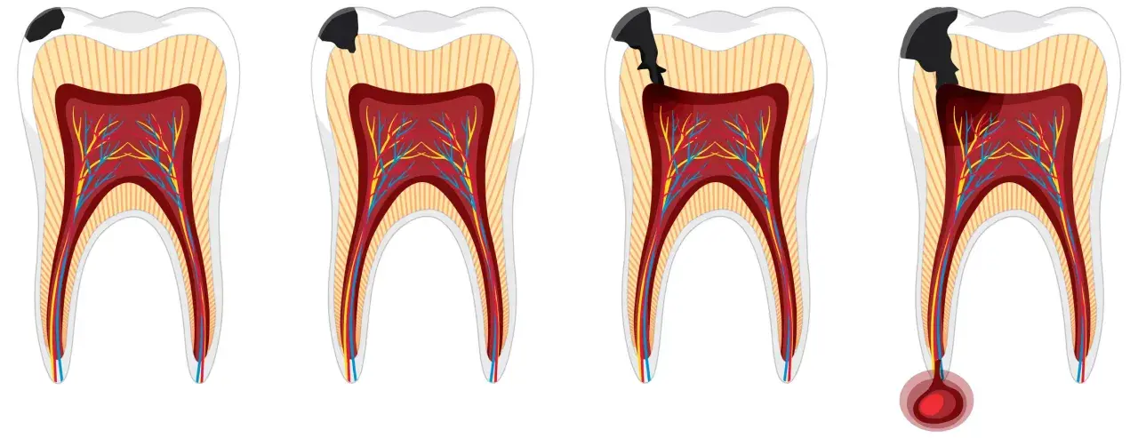 Secuencia de caries que avanza hacia la pulpa dental, mostrando la progresión de la pulpitis muela.