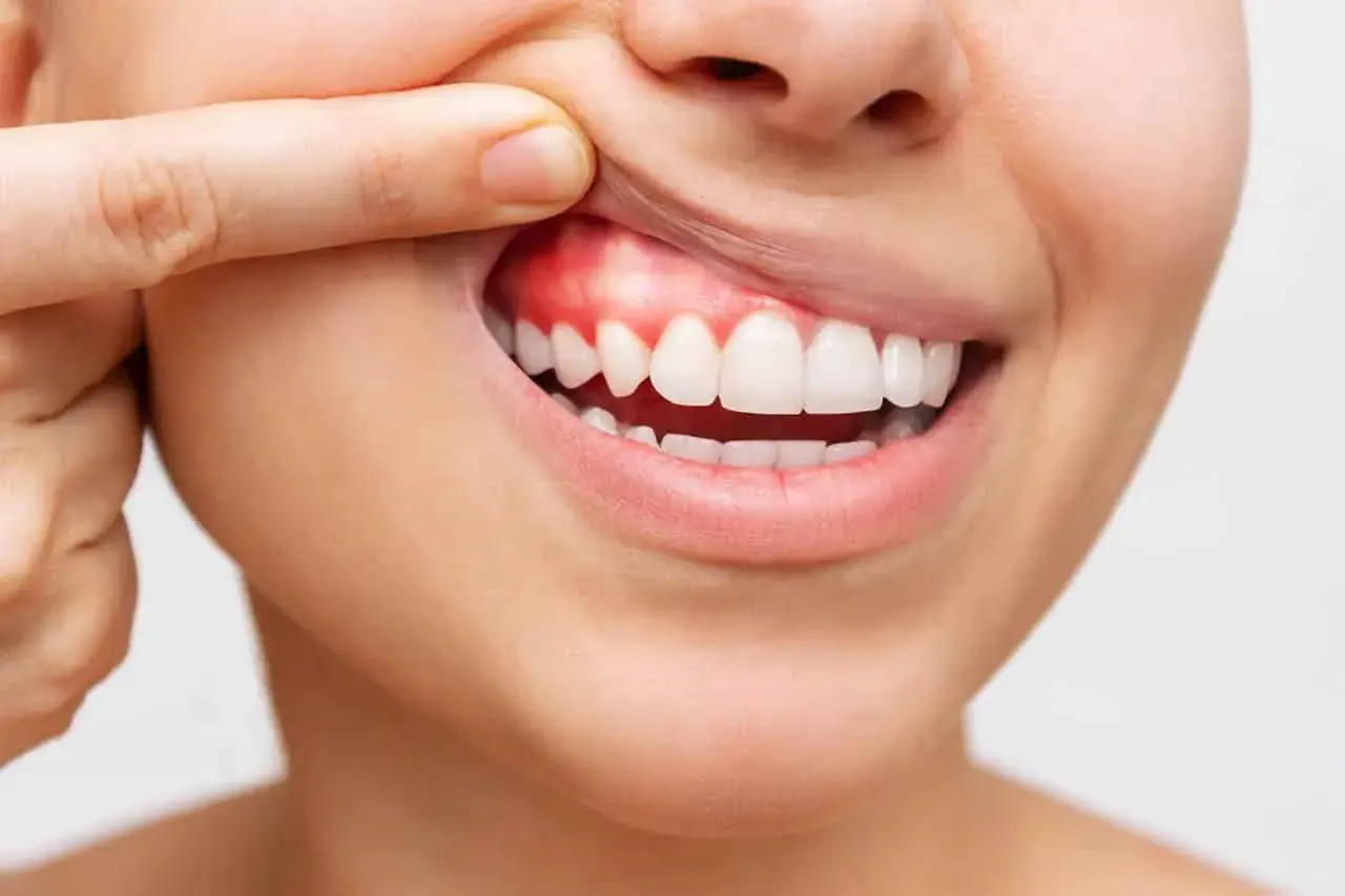 Dente con un piccolo puntino bianco sulla gengiva infiammata, evidenziato da un dito.
