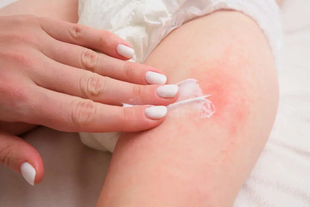 Mano applica crema su pelle arrossata, per la cura dell'intertrigine glutei.