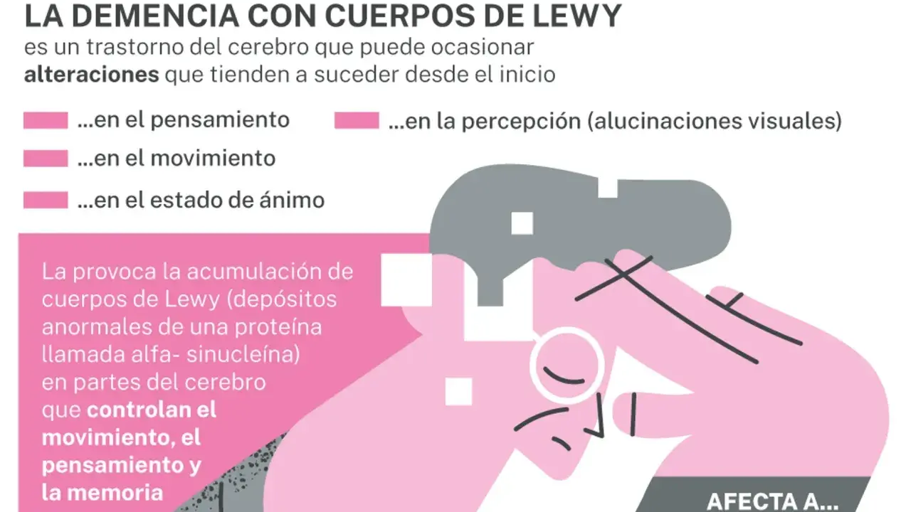 La demencia con cuerpos de Lewy afecta pensamiento, movimiento, ánimo y percepción. Se debe a depósitos de proteína alfa-sinucleína en el cerebro.