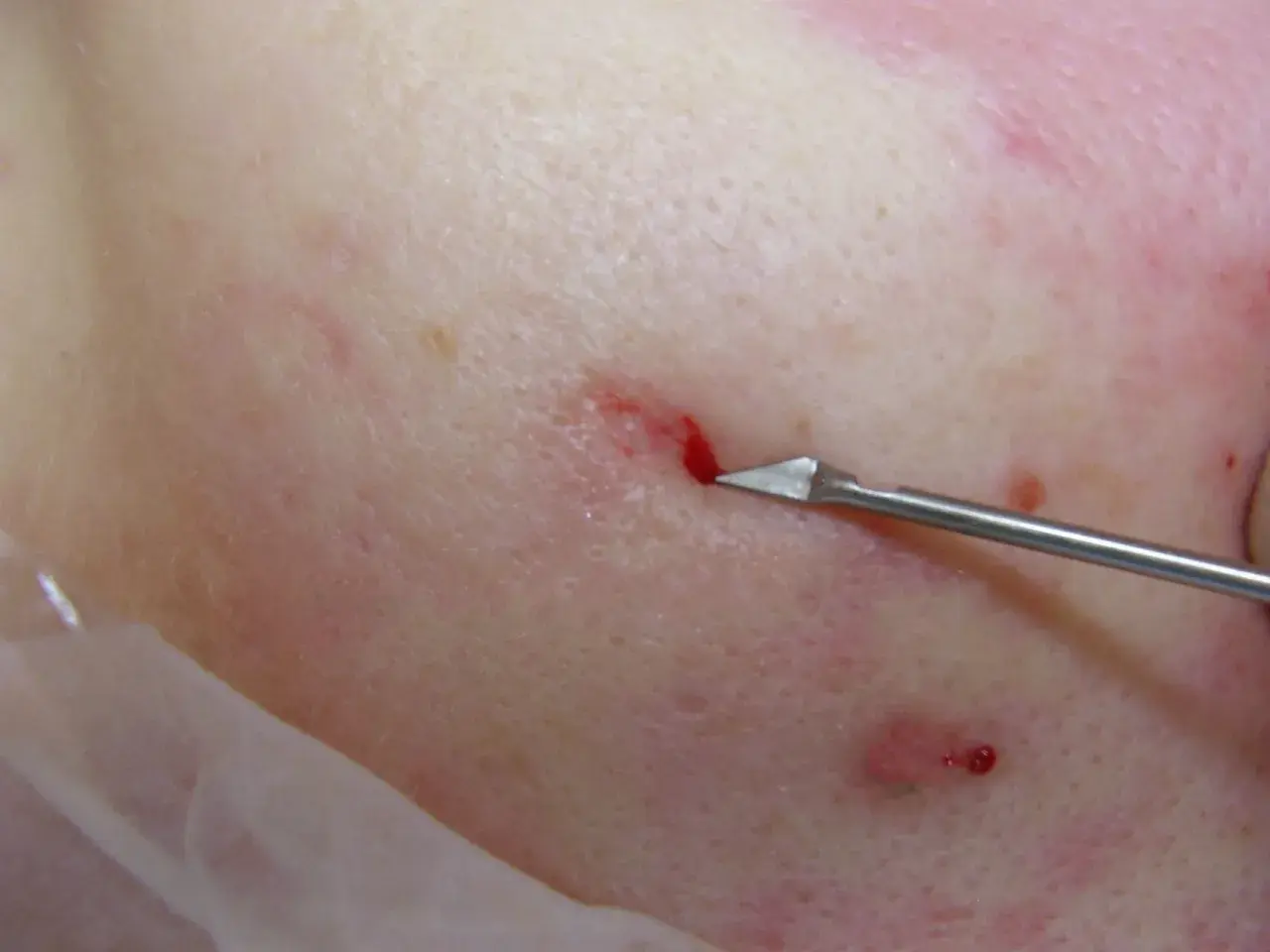 Närbild på hud där en subcision behandling utförs med ett vasst instrument som skär under ärr.