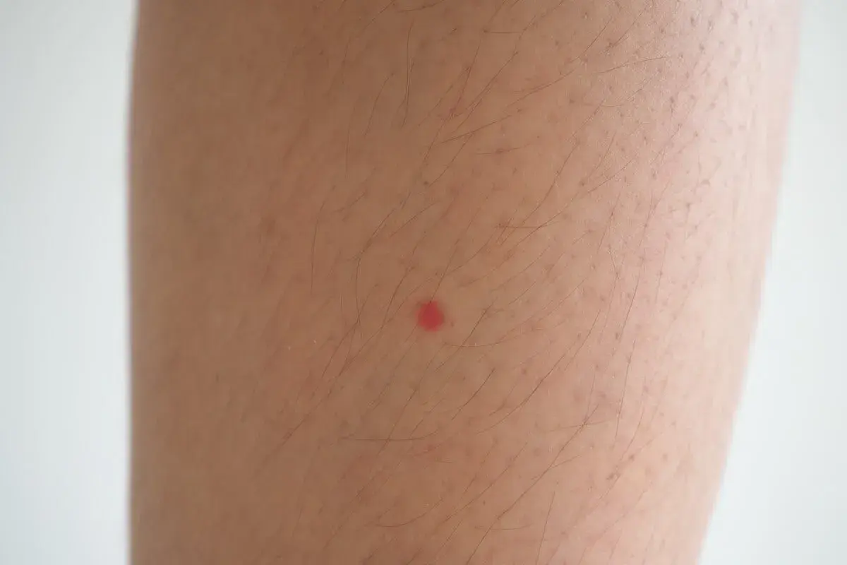 Una pequeña mancha roja en la pierna, quizás una picadura de insecto, resalta sobre la piel con vello.