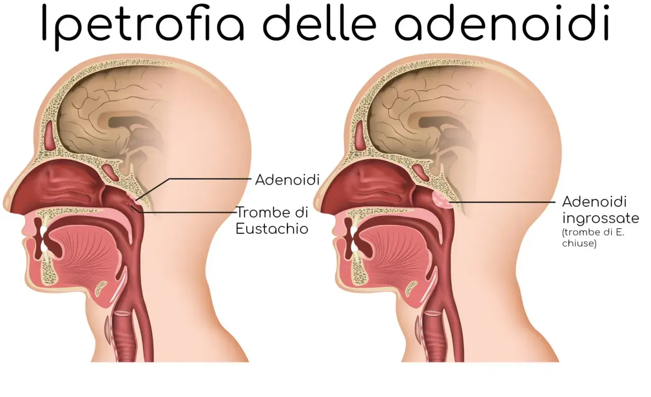 Confronto tra adenoidi normali e ingrossate che ostruiscono le trombe di Eustachio.