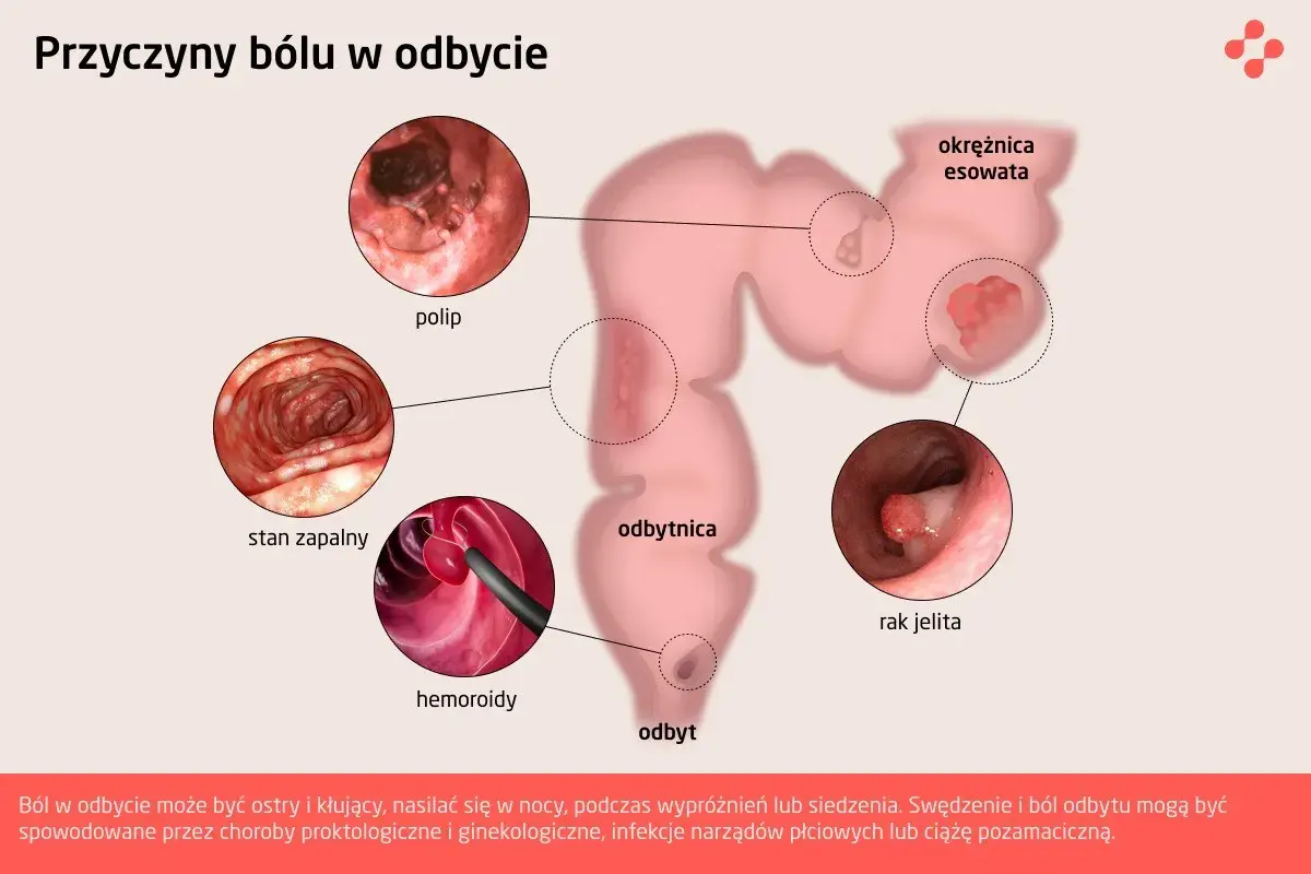 Ilustracja przedstawia przyczyny bólu w odbycie: polipy, stan zapalny, hemoroidy, raka jelita, okrężnicę esowatą.