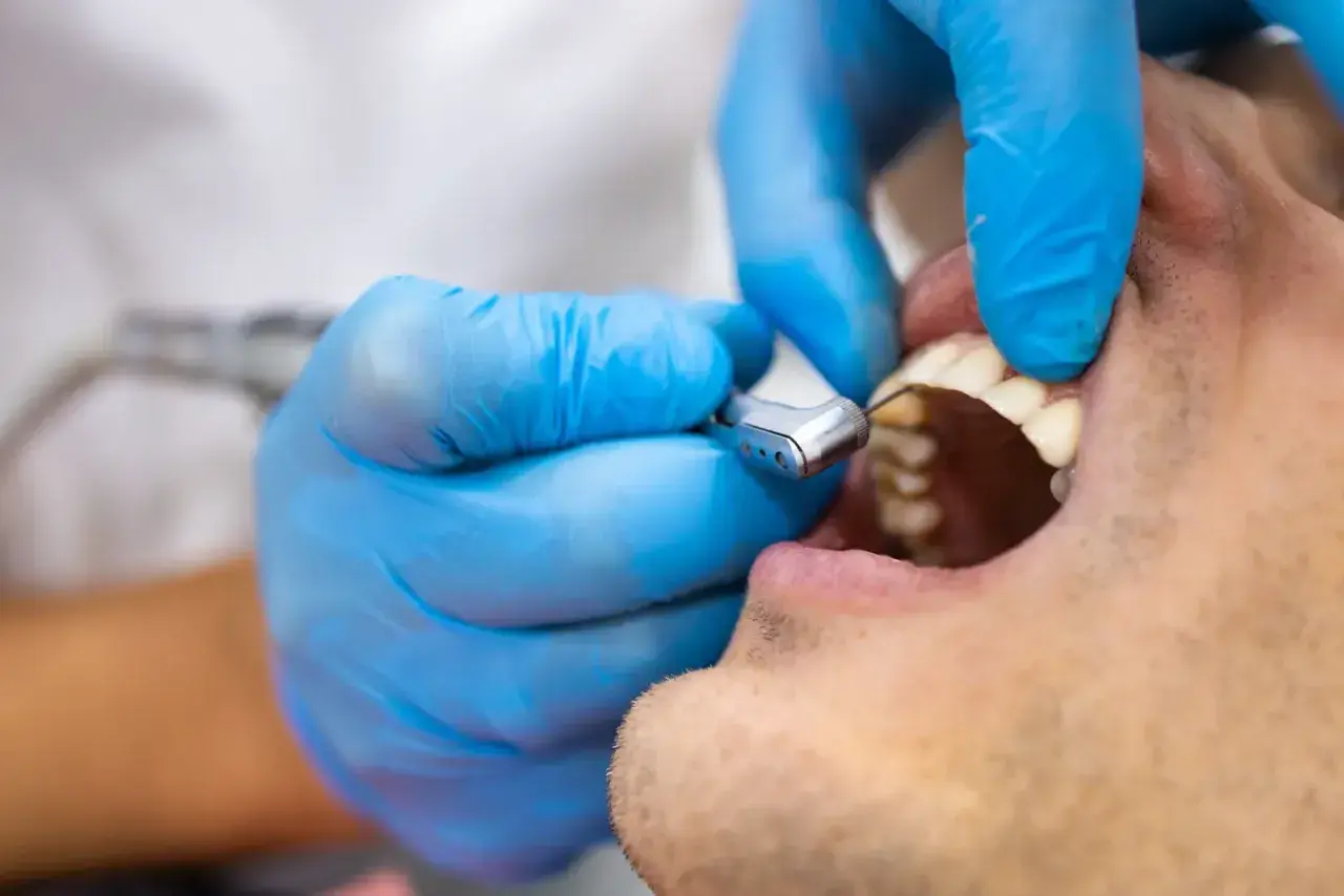 Dentysta w niebieskich rękawiczkach używa wiertła stomatologicznego do leczenia zęba, który może być dotknięty zatruciem.