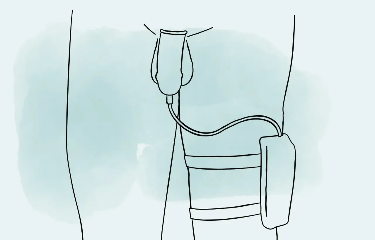 Illustration zeigt, wie man ein Urinalkondom anlegt. Ein Schlauch verbindet das Kondom mit einem Auffangbeutel am Bein.