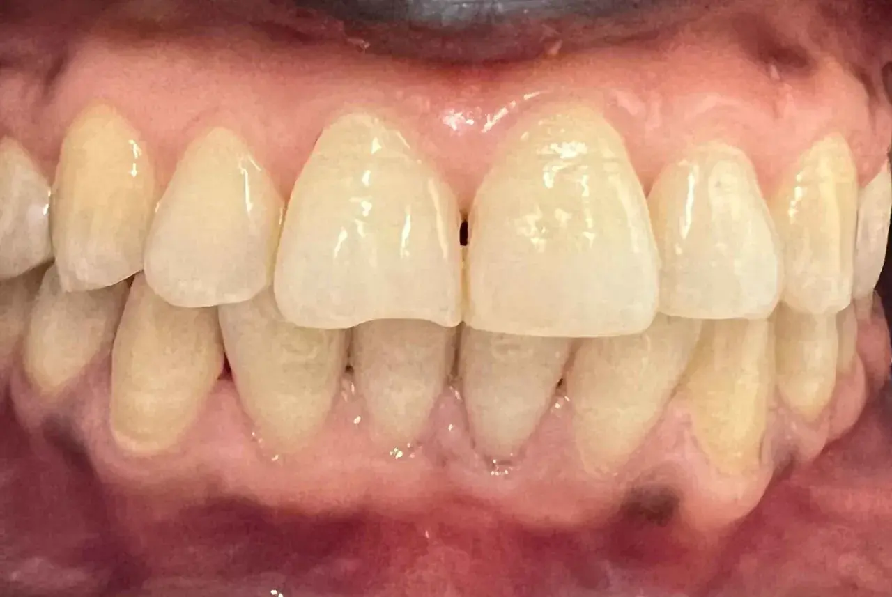 Primer plano de dientes y encías, mostrando algunas manchas oscuras en las encías.