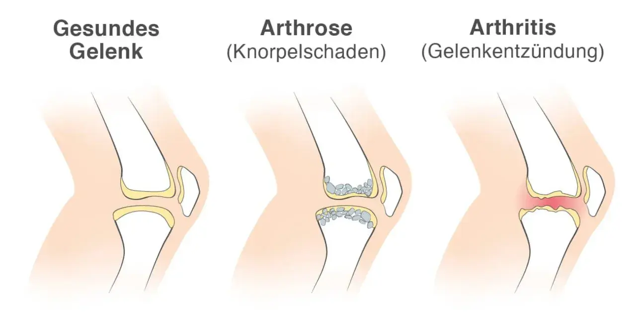 Vergleich von Gelenken: gesund, Arthrose (Knorpelschaden) und Arthritis (Gelenkentzündung). Arthritis zeigt eine Entzündung im Gelenk.