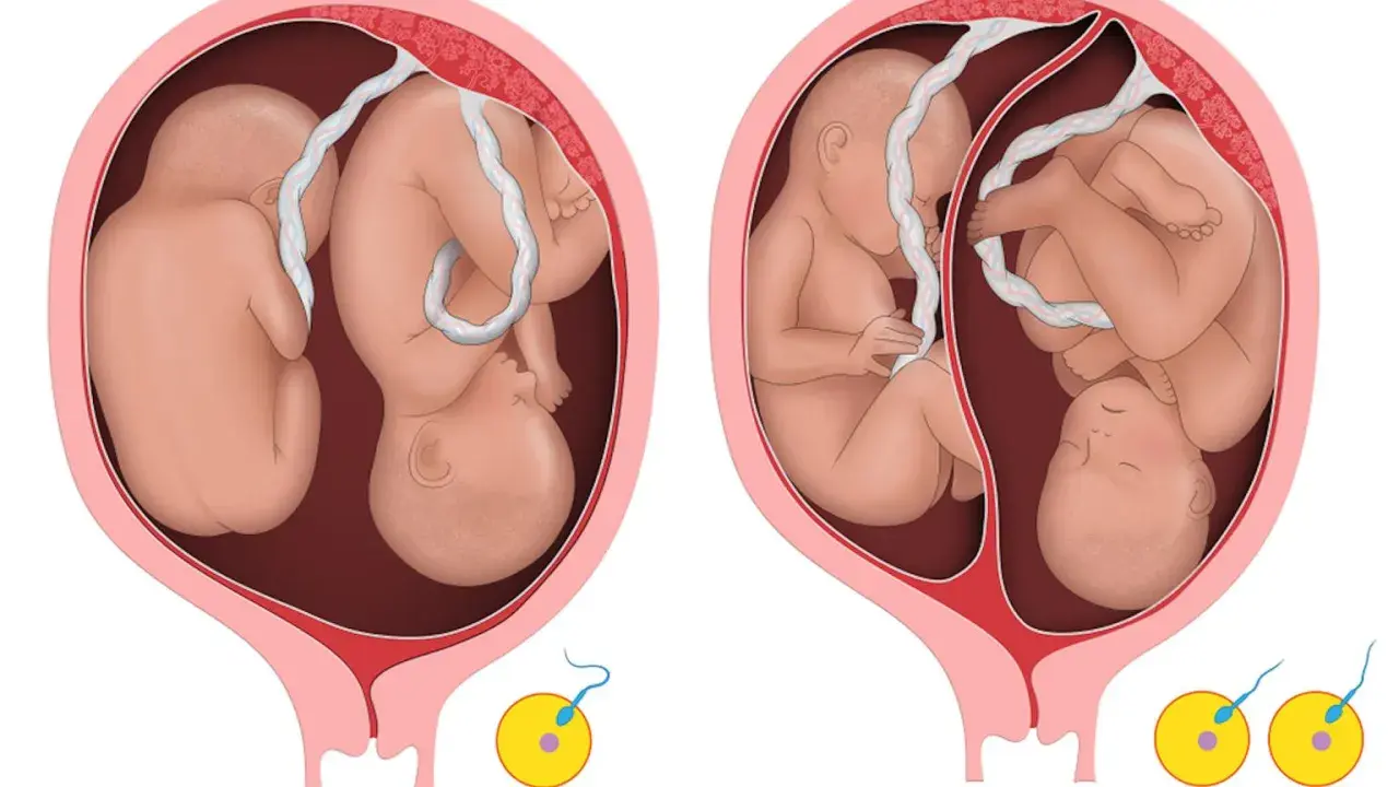 Dwa płody w macicy, ilustracja pokazująca niezauważona ciąża mnoga. Dwa zarodki z plemnikami poniżej.