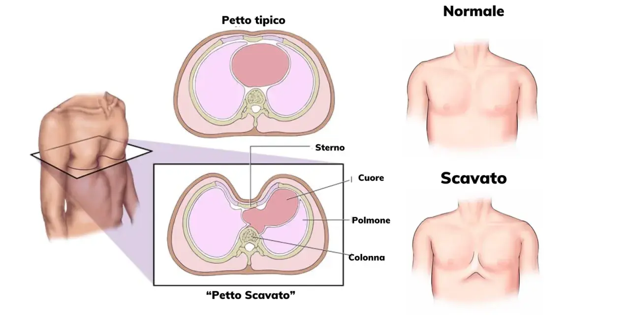 Confronto tra petto tipico e petto escavato nei bambini. Illustrazione anatomica mostra la forma del torace e la posizione degli organi interni.