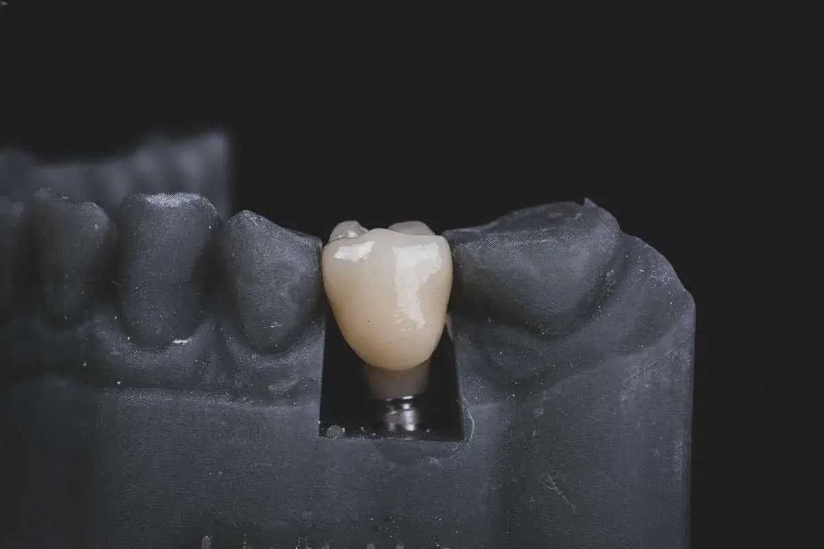 Modello di arcata inferiore con impianto dentale e corona in ceramica.