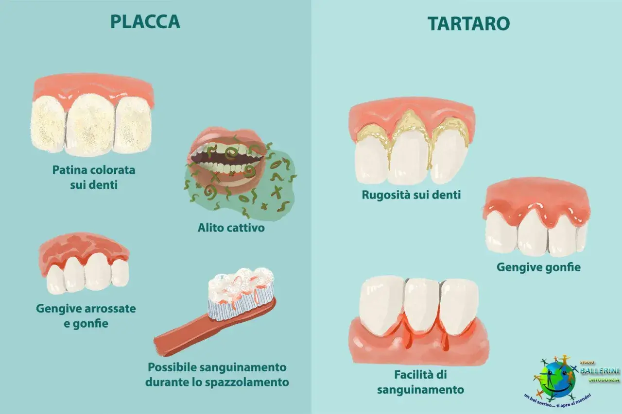 Illustrazione che mostra la differenza tra placca e tartaro: la placca causa patina, alito cattivo e gengive gonfie; il tartaro provoca rugosità, gengive gonfie e sanguinamento.