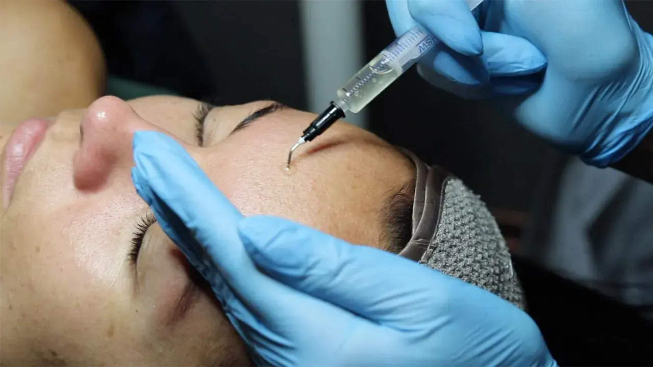 Close-up of a person receiving a PRX-T33 facial treatment with a syringe applying solution to the forehead.