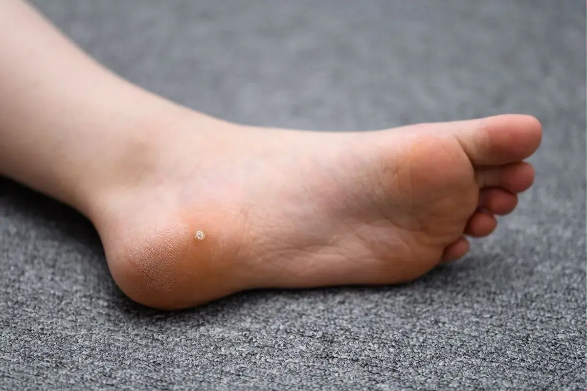 Piede di un bambino con una piccola verruca sul tallone.