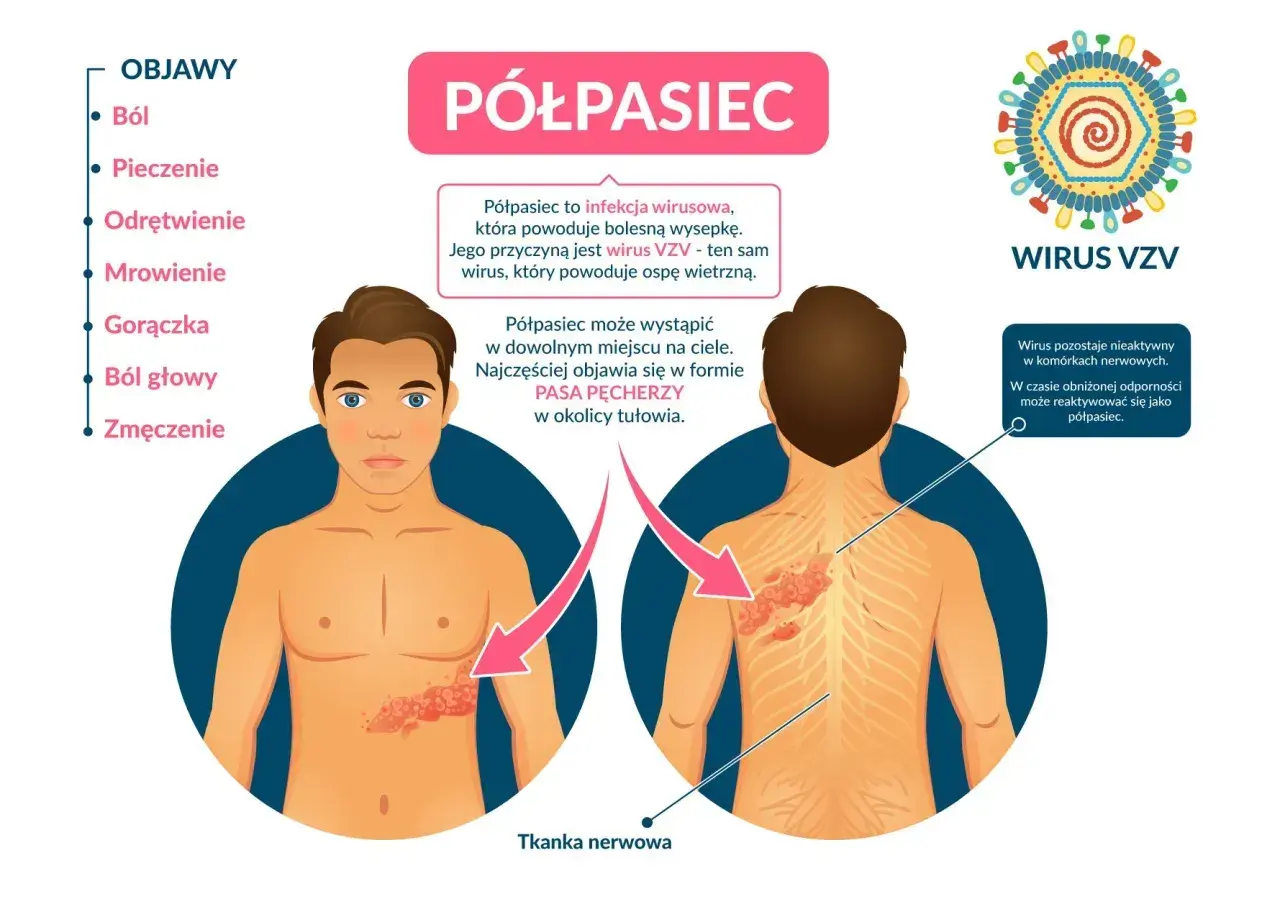 Półpasiec to wirusowa choroba objawiająca się bólem i wysypką. Czy półpasiec jest zaraźliwy? Nie, ale wirus VZV może się reaktywować.