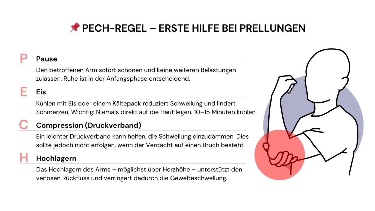 Erste Hilfe bei Prellungen: PECH-Regel erklärt. Bei einer Prellung am Unterarm sofort Pause machen, Eis kühlen, Compression anlegen und den Arm hochlagern.