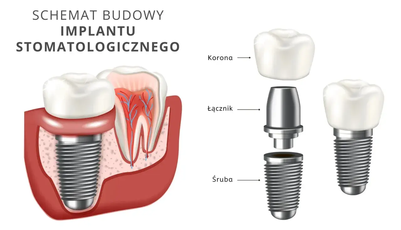 Schemat budowy implantu stomatologicznego. Dowiedz się, ile kosztuje implant zęba 6 i jak jest zbudowany: śruba, łącznik i korona.