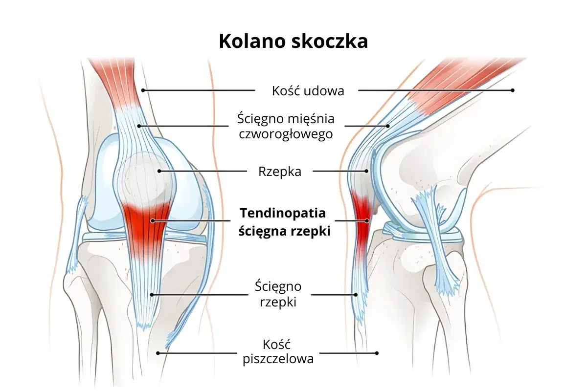 Ilustracja przedstawia anatomię kolana, ukazując problem "kolana skoczka" – zapalenie ścięgna rzepki.
