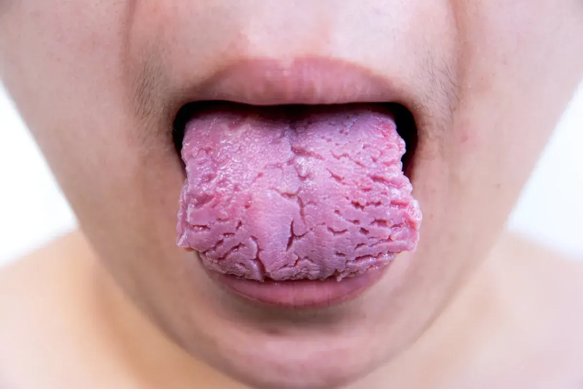 Lengua rosada con aspecto agrietado, como si tuviera una herida, sobresale de unos labios.