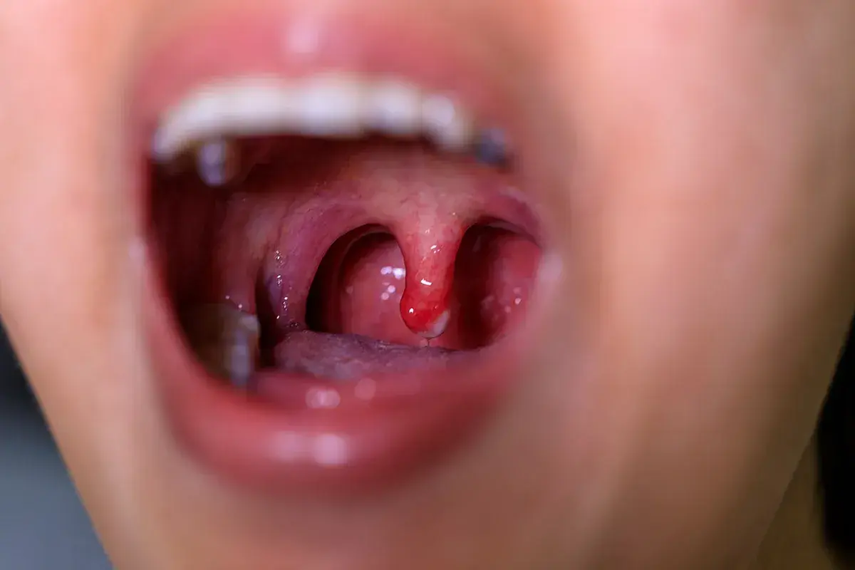 Gola arrossata con tonsille gonfie e una piccola lesione, indicativa di mucosite orale.