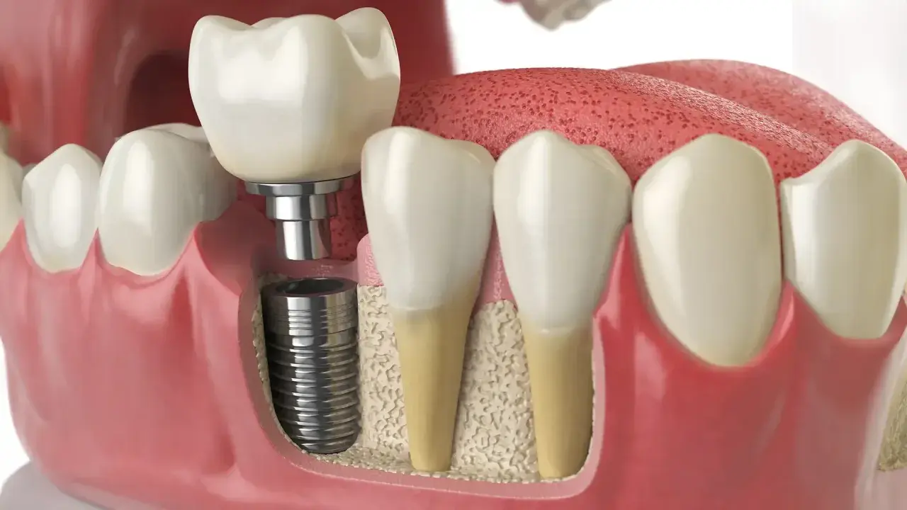 Immagine 3D di un impianto dentale inserito nell'osso, con una corona in cima. Si vedono anche denti naturali e gengive. Informazioni su innesto osseo dentale effetti collaterali.