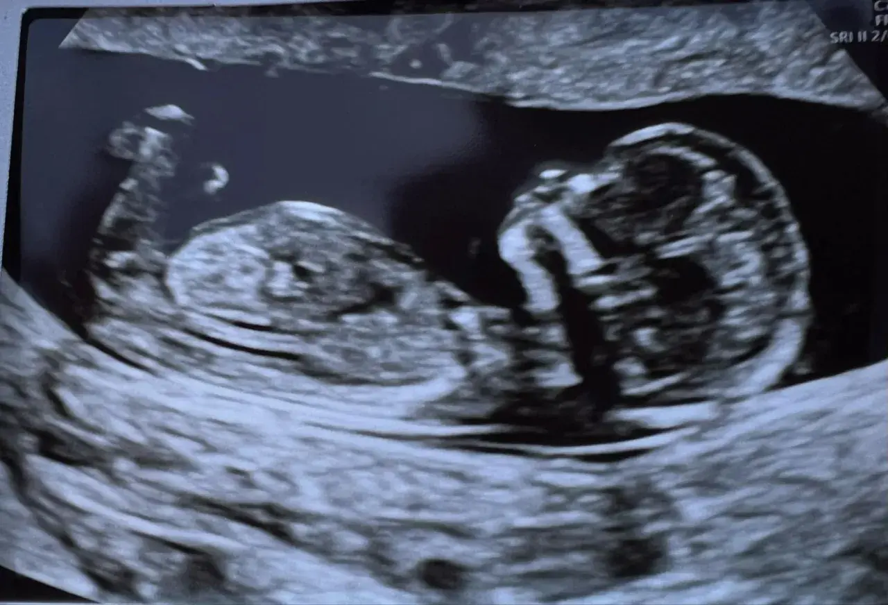 Ecografia 14 settimane: profilo del feto, testa e corpo visibili. Si attende di scoprire se è maschio o femmina.
