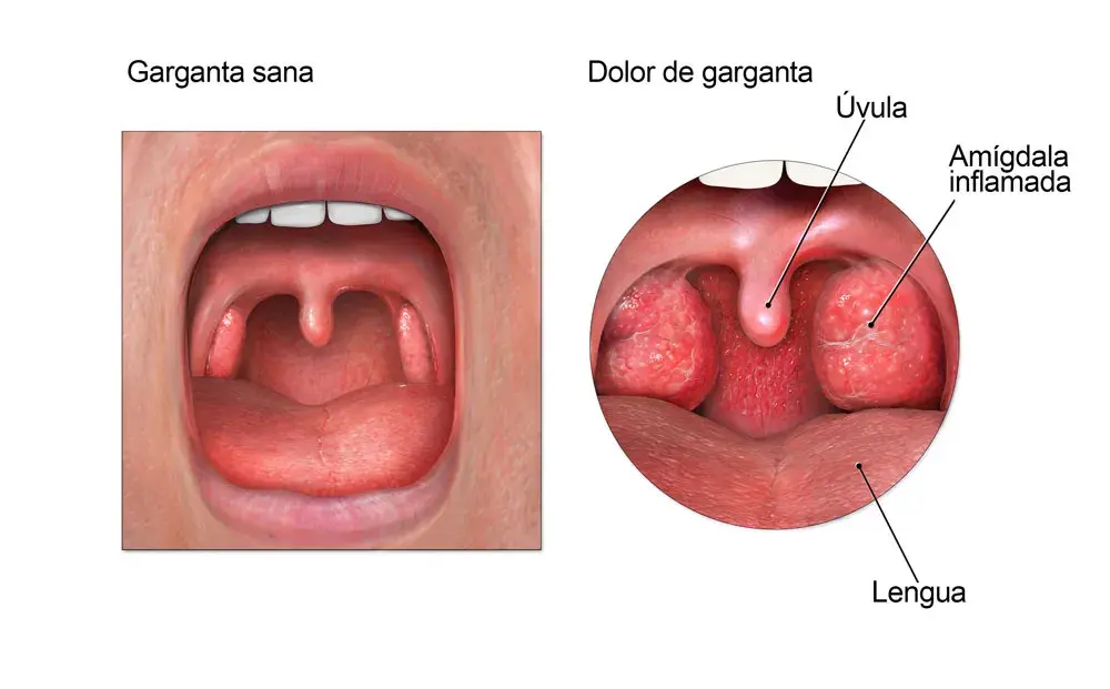 Medicamentos para el dolor de garganta: alivia el malestar rápidamente