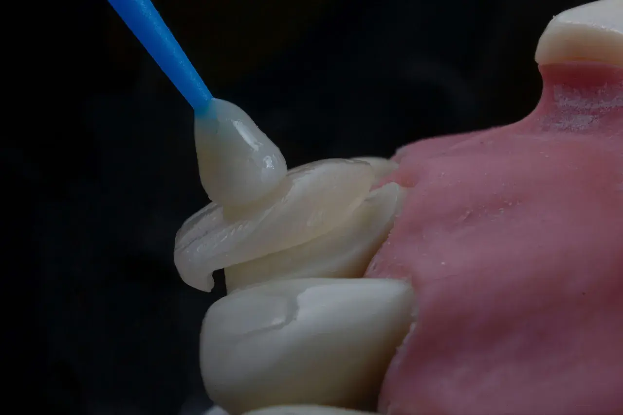 Precyzyjna odbudowa zęba na włóknie szklanym. Dentysta aplikuje materiał na model.
