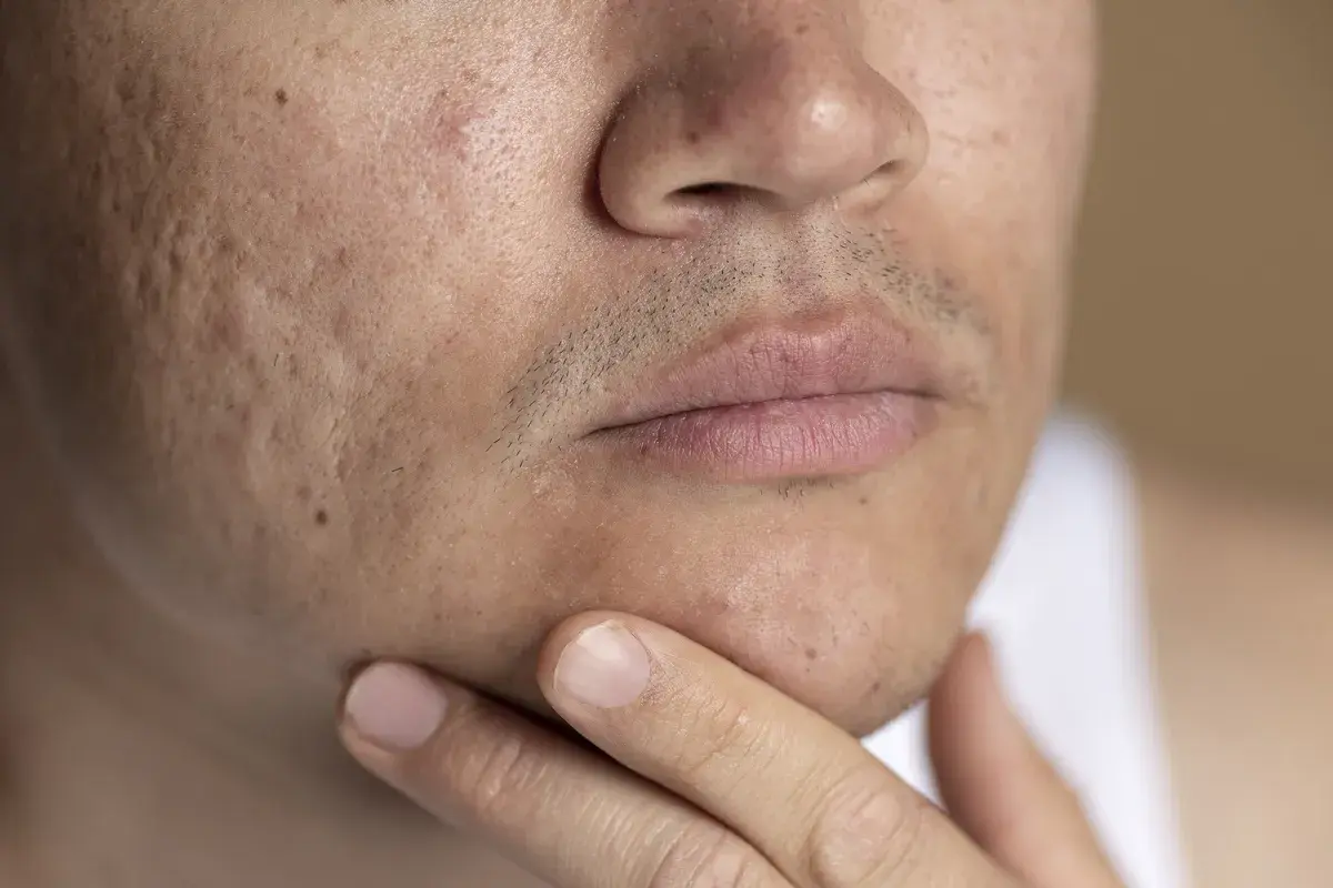 Primer plano de un rostro masculino con marcas de acné visibles en la mejilla y la barbilla.