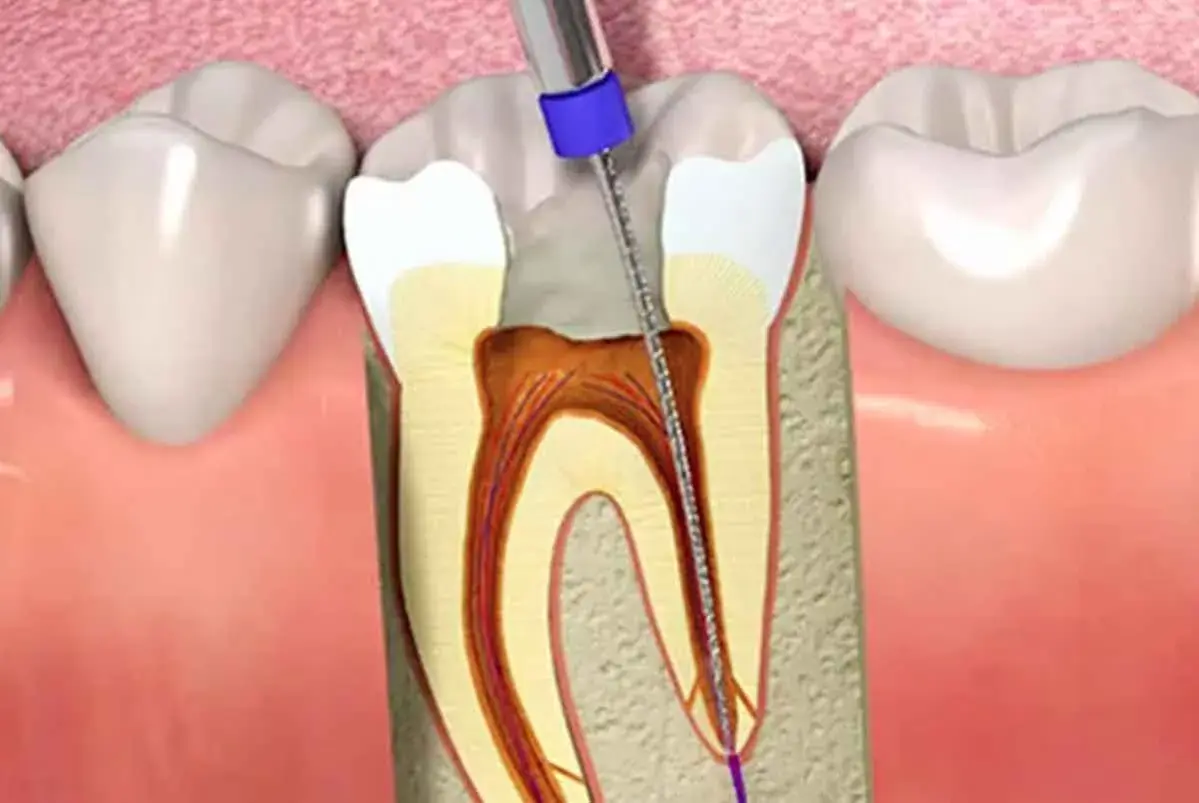 Procedimiento dental: un instrumento limpia el nervio de una muela al aire, mostrando el interior del diente.
