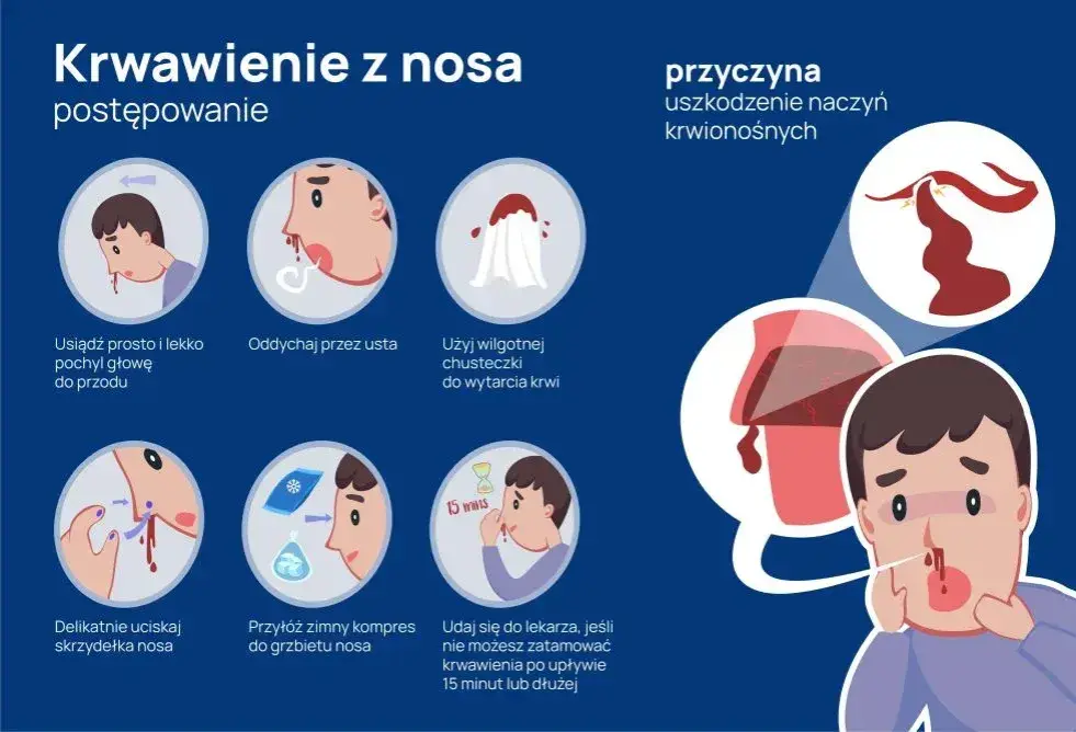 Krwawienie z nosa przyczyny: najczęstsze powody i co z nimi zrobić.