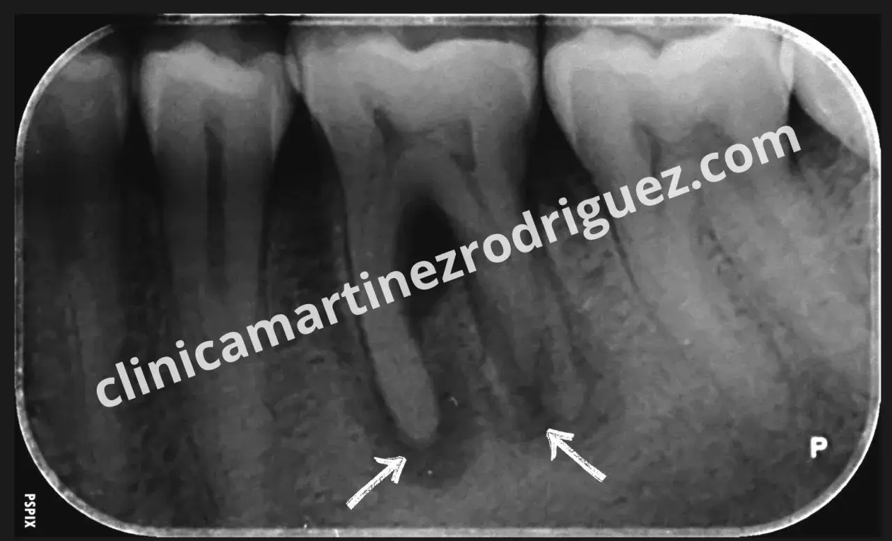 Radiografía dental muestra una posible infección endodoncia con áreas radiolúcidas en ápices radiculares, señaladas por flechas.