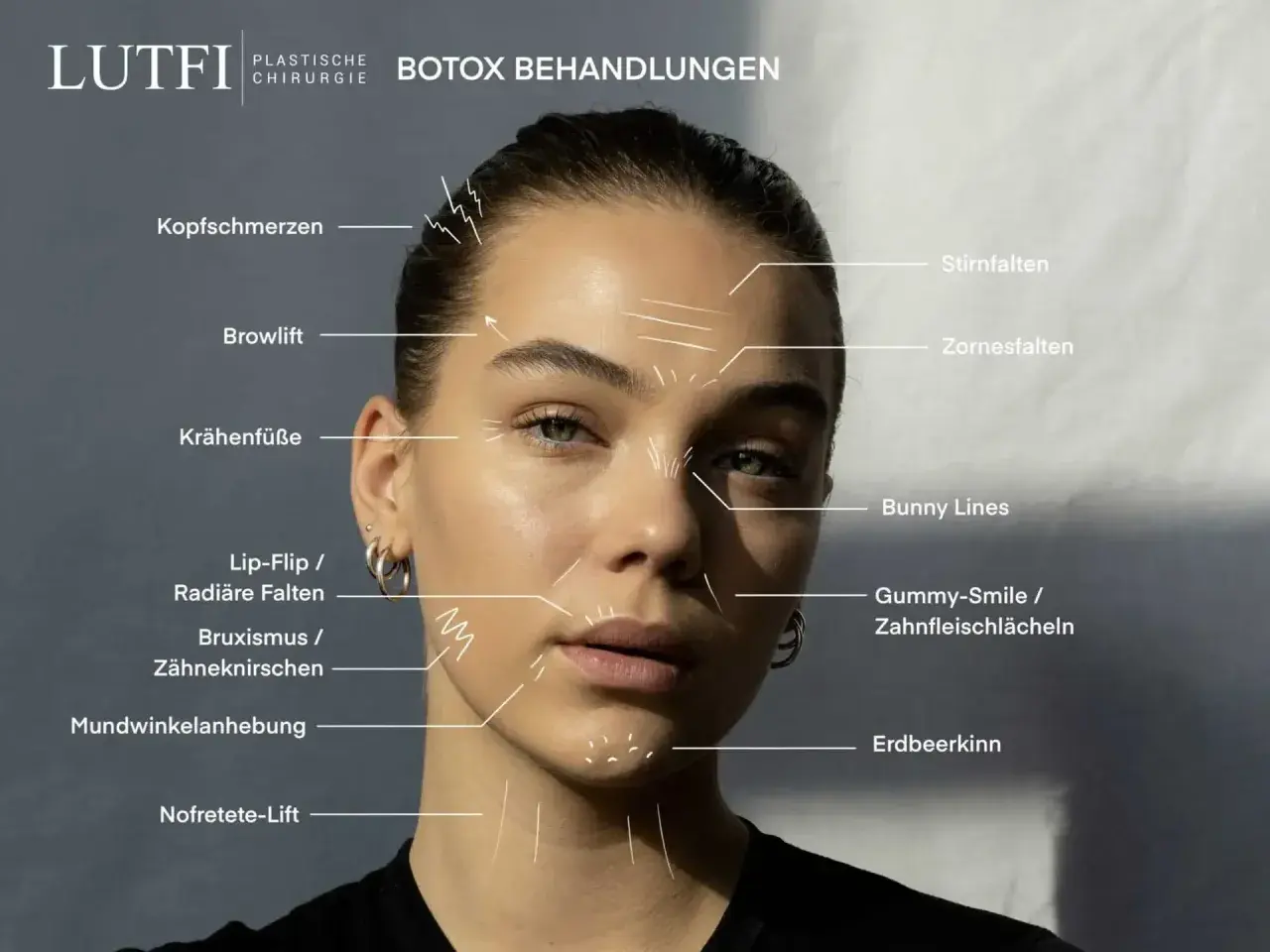 Botox-Behandlungen gegen Zornesfalten, Stirnfalten und Krähenfüße. Auch für Lippenlifting, Mundwinkelanhebung und mehr.