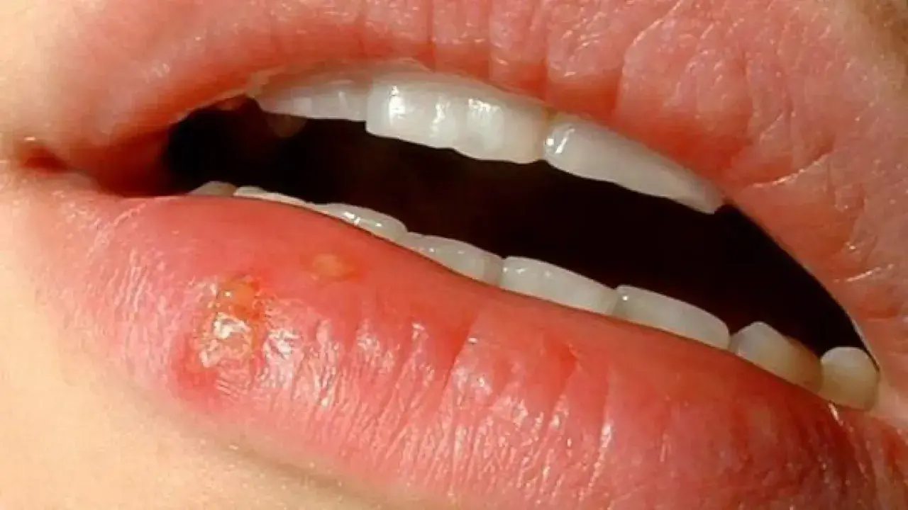 Labio con herpes, ampollas y costras. ¿Cuánto dura un herpes labial?