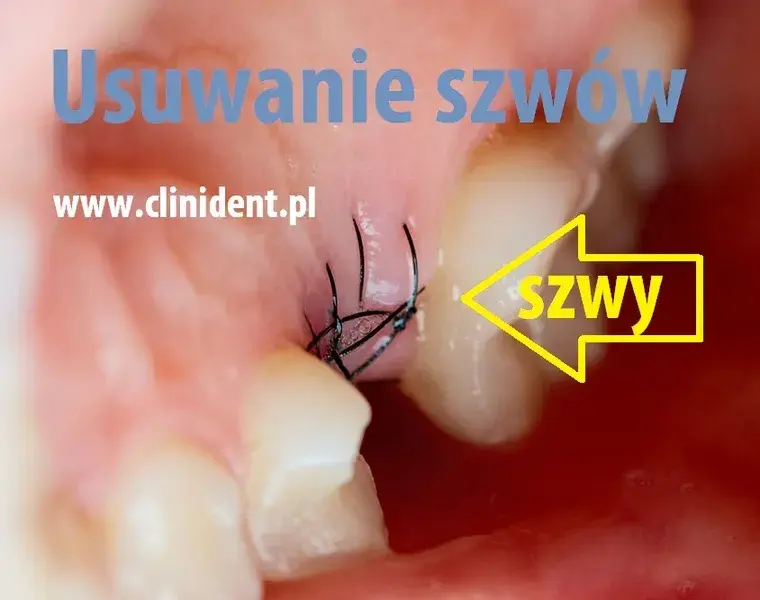 Zdjęcie szwów u dentysty: Koszt, NFZ i jak zaoszczędzić?