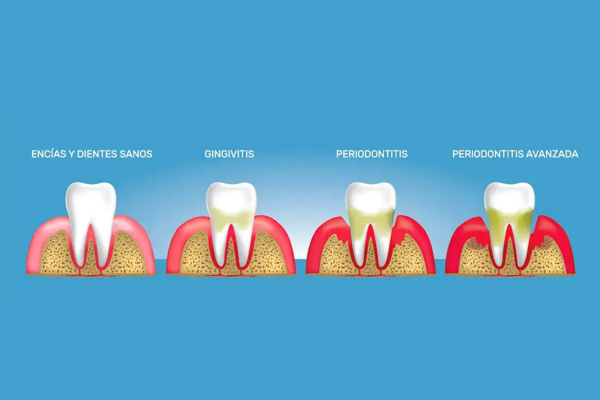 Ilustración muestra la progresión de la gingivitis a periodontitis, con encías y dientes sanos, gingivitis, periodontitis y periodontitis avanzada.