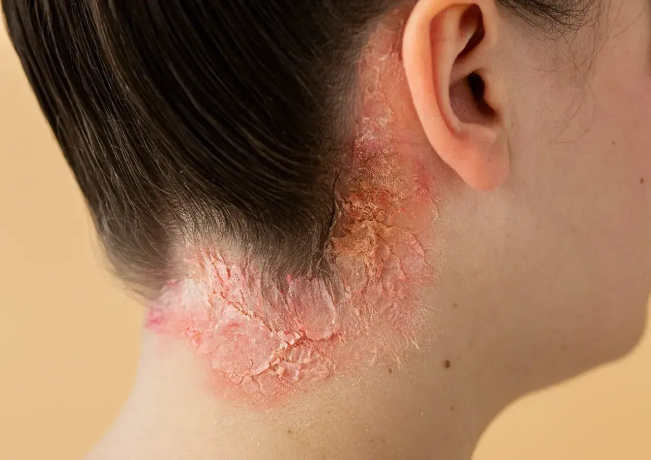 Piel irritada y escamosa en el cuello, posible alergia al cloro de piscina que causa problema respiratorio.