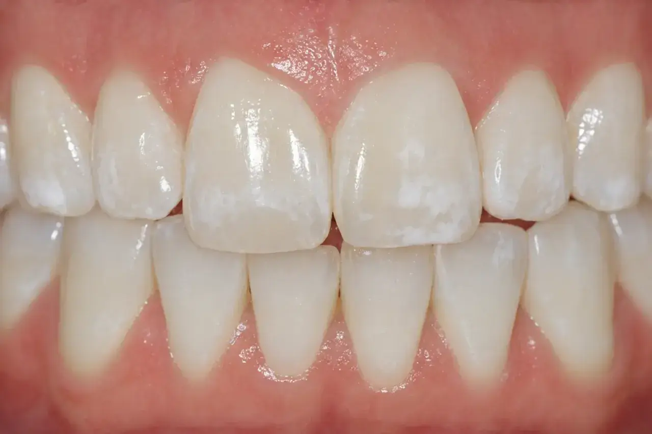 Denti con macchie bianche visibili, che potrebbero indicare problemi di smalto o ipomineralizzazione.