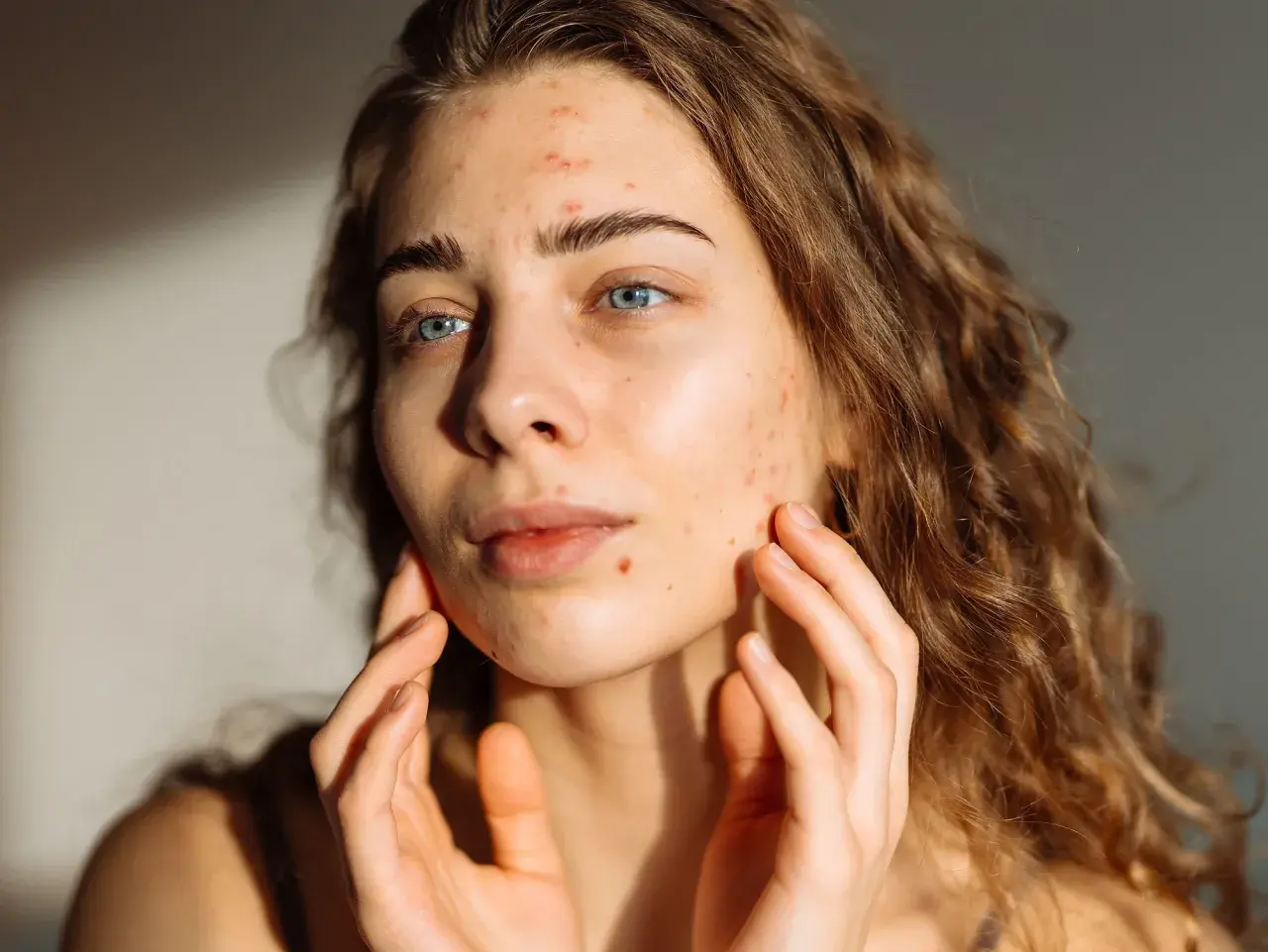 Junge Frau mit Akne im Gesicht, die sich besorgt die Wangen berührt. Mögliche isotretinoin nebenwirkungen.
