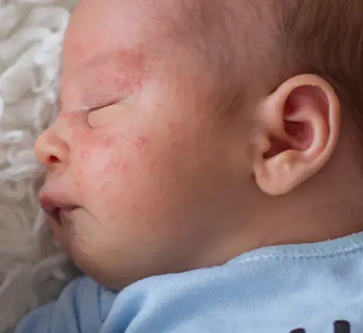 Alergia na BMK u niemowlaka: Objawy, które musisz znać!