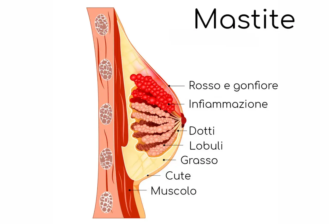 Illustrazione anatomica del seno che mostra infiammazione e rossore, sintomi comuni di dolore al seno durante l'allattamento.