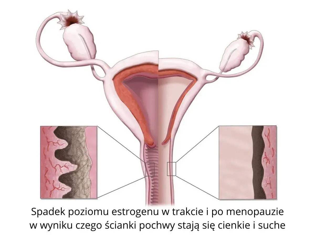 Ilustracja pokazuje, jak spadek estrogenu po menopauzie prowadzi do atrofii pochwy, powodując ścieńczenie i suchość jej ścianek.